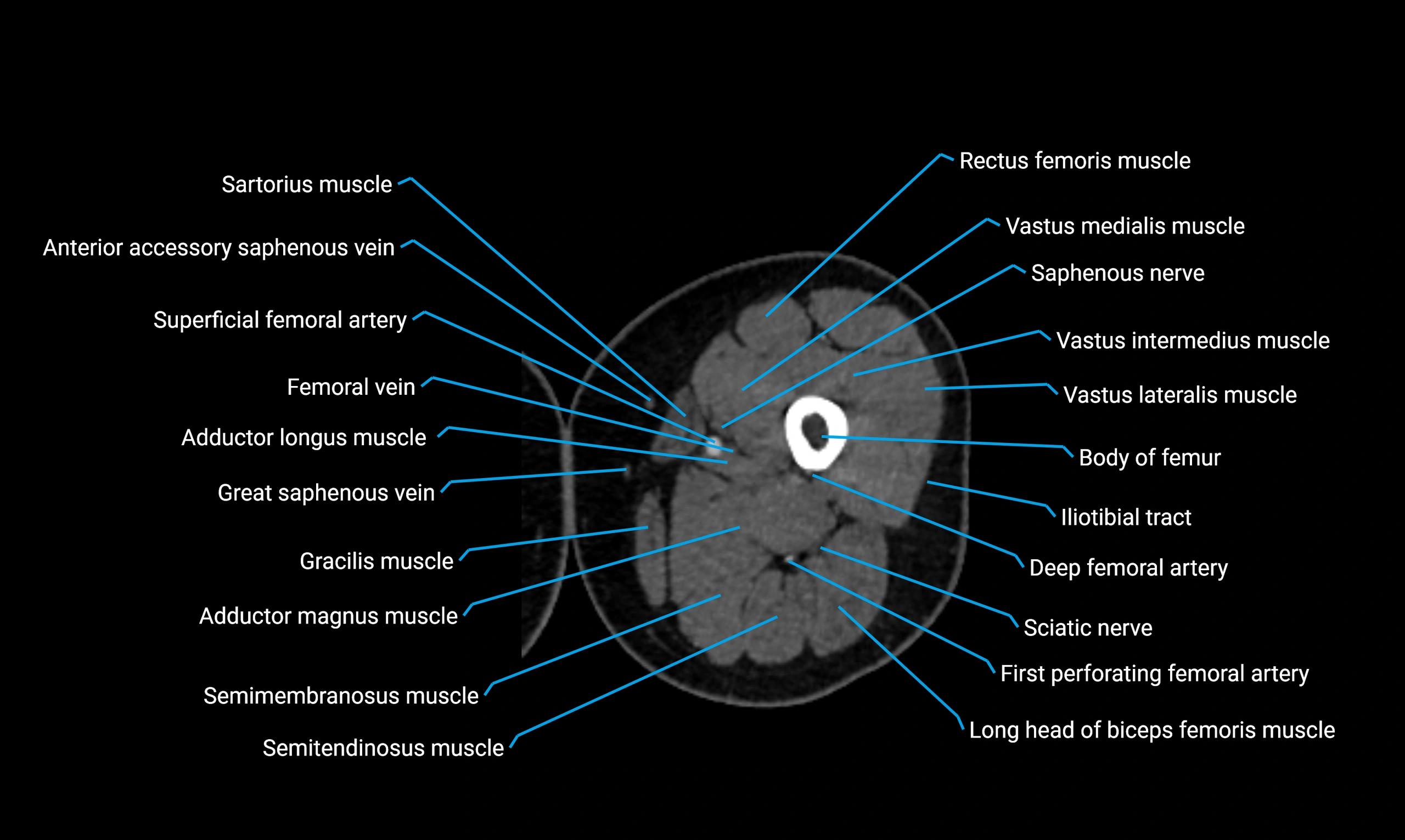 CT lower limb axial cross sectional anatomy labelled image 49 (2).webp
